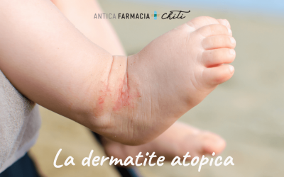La dermatite atopica: cos’è e come curarla